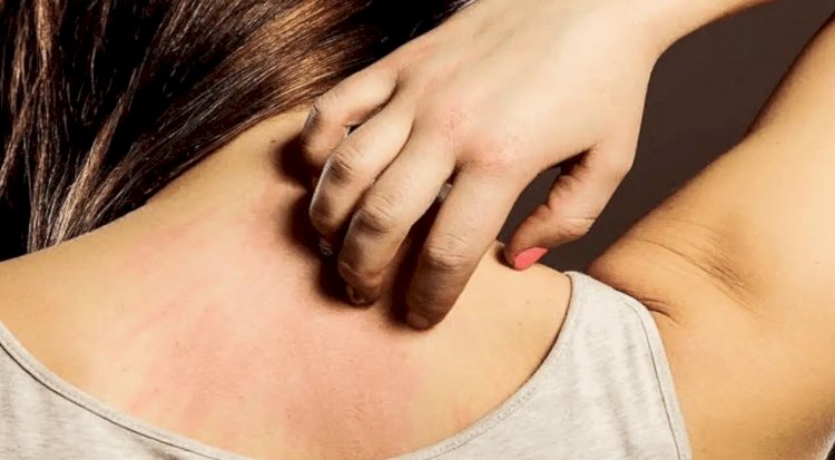 هؤلاء لديهم حساسية الطعام