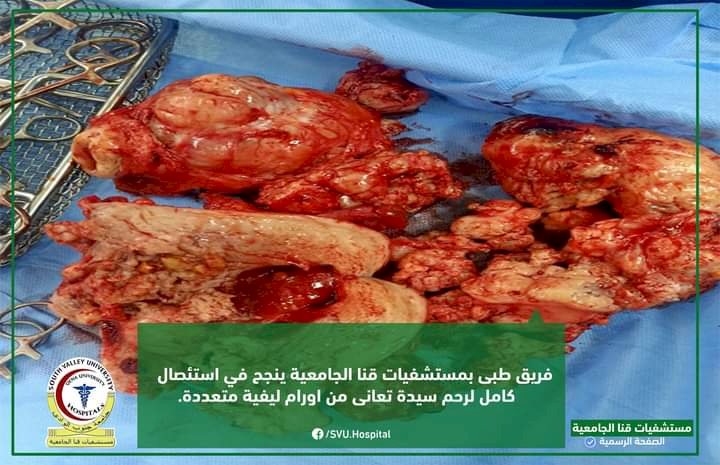 استئصال كامل لرحم سيدة تعاني من اورام متعددة بمستشفيات قنا