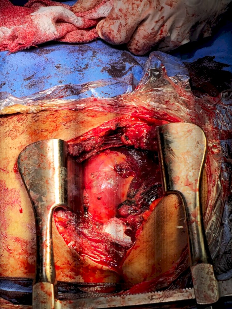 فريق طبي بمستشفي سوهاج الجامعي الجديد ينجح في إنقاذ شاب تعرض لطعنة نافذة في القلب