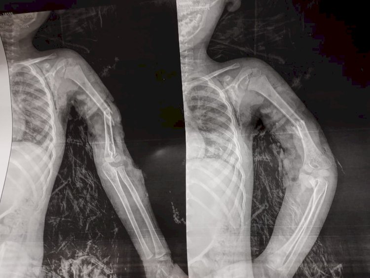 فريق طبي بمستشفي سوهاج الجامعي ينقذ ذراع طفل من "بتر" كامل
