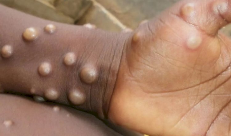 وزارة الصحة ترفع درجة الإستعداد القصوي للحماية من مرض جدري القرود