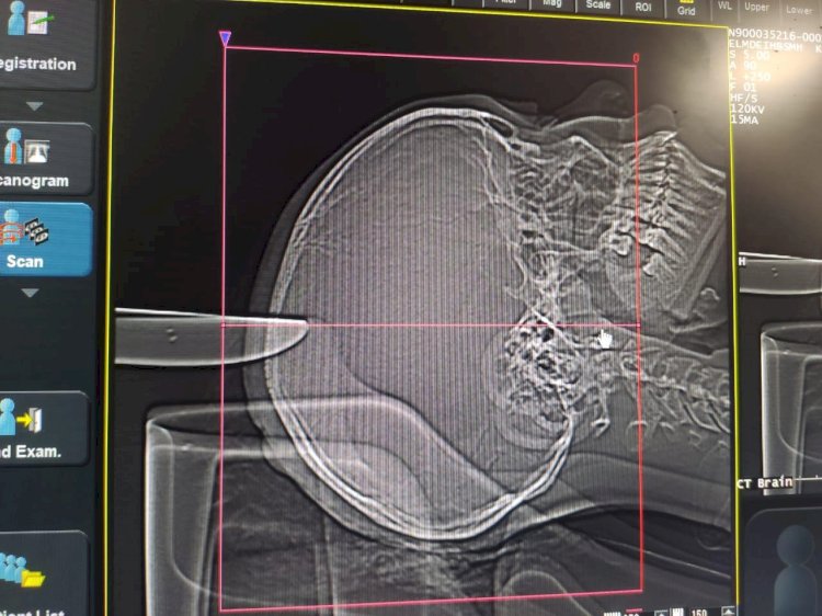 إيقاف نزيف بالمخ لطفله بعد طعنها بسكين فى الرأس