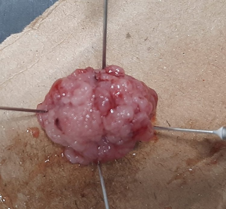 نجاح استئصال ورم سطحي بالقولون باستخدام تقنية مناظير الفراغ الثالث بمستشفيات قنا الجامعية