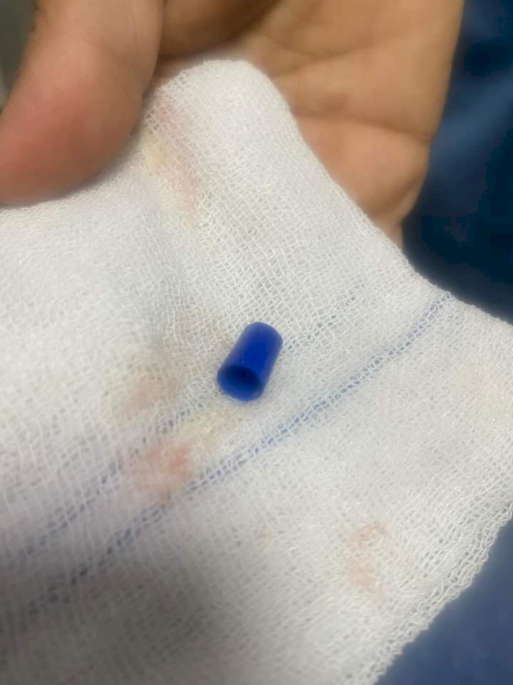 فريق طبى ينجح في استخراج جزء بلاستيك من القلم الجاف لطفل يبلغ من العمر 3 أعوام