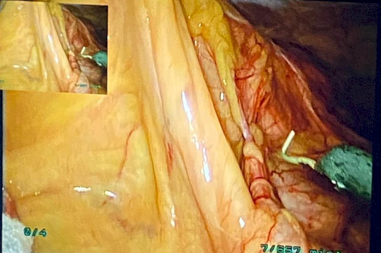 سوهاج الجامعي تستئصل ورمًا بالقولون طوله ١٠ سم لمريض ٦٥ عاما