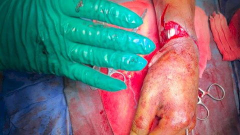 فريق جراحة التجميل بعد 6 ساعات .. أطباء جامعة أسوان يعيدون يدًا مبتورة